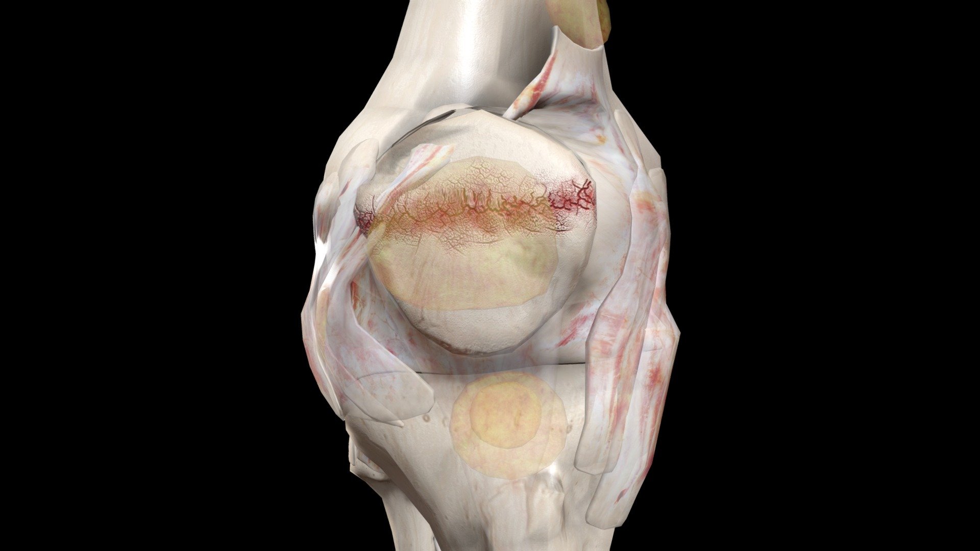 Undisplaced Patella Fracture 3D model by Connections XR