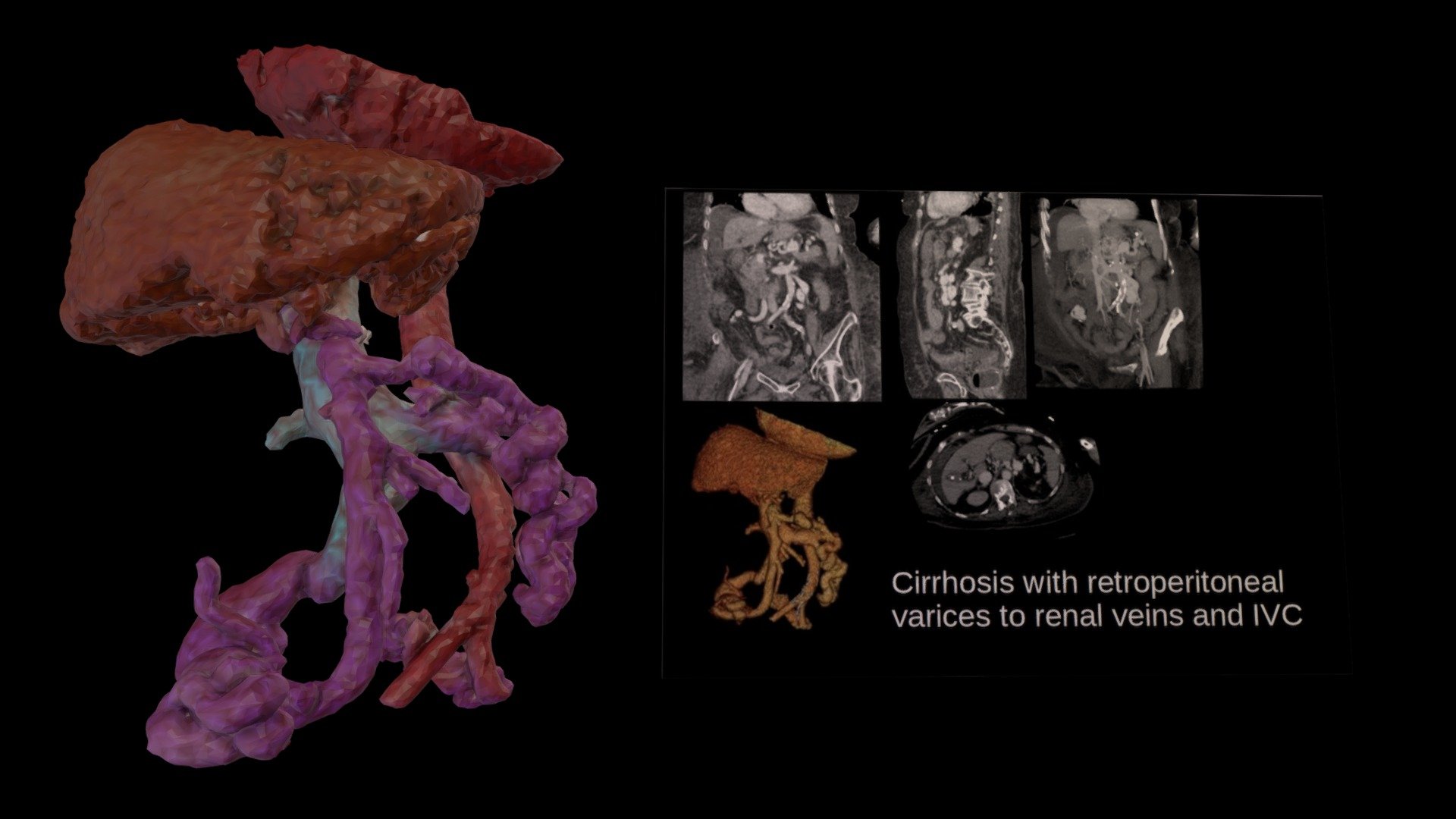 Cirrhosis, Portal Vein Cavernous Transformation