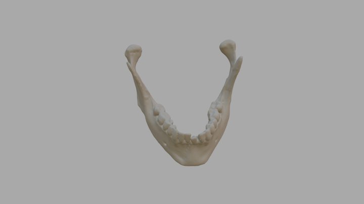 Mandibule fracture: Condylar process 3D Model