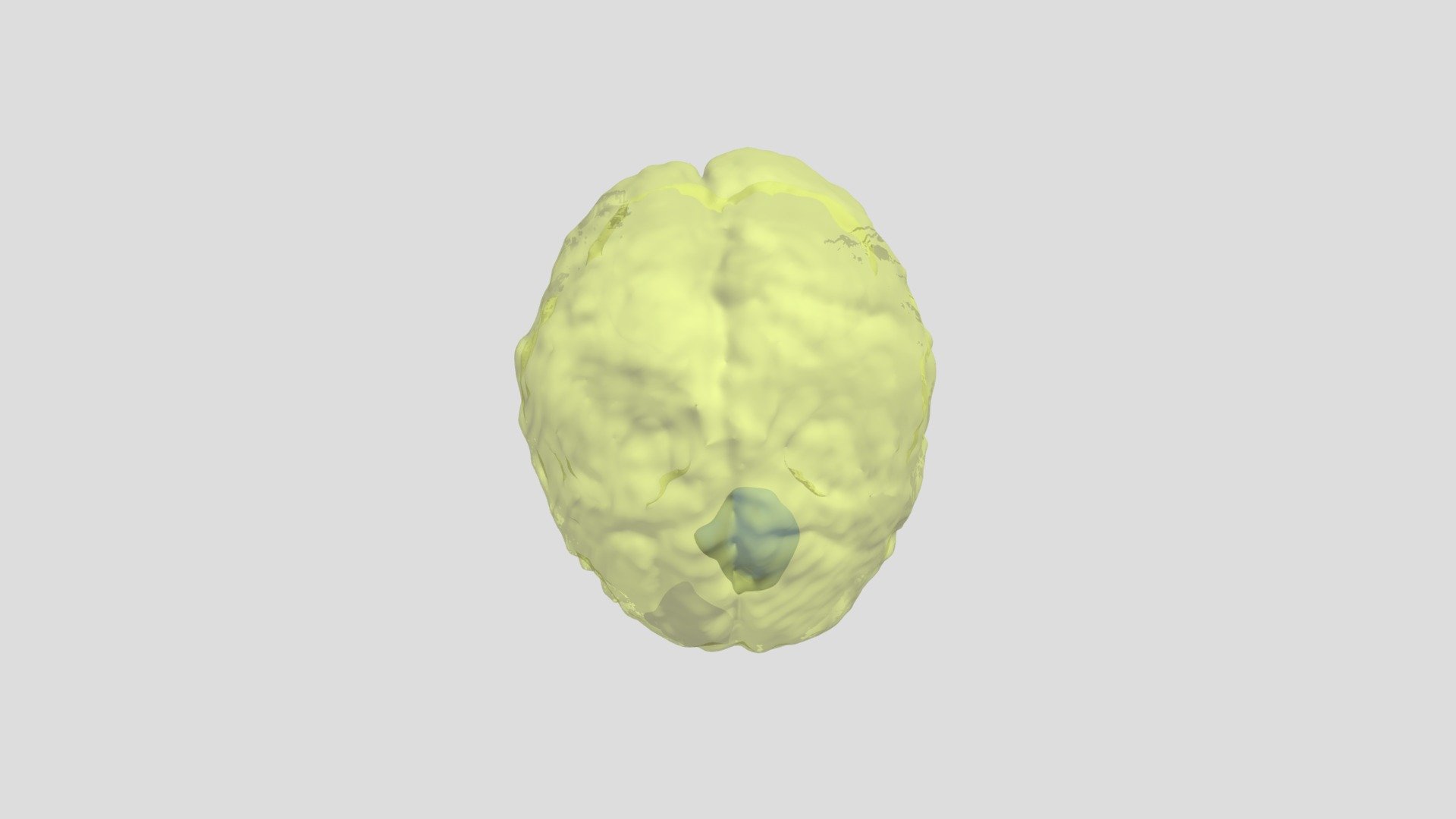 Tumors