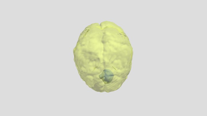 Tumors 3D Model