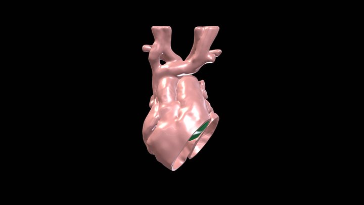 Coronal cut with patch 3D Model