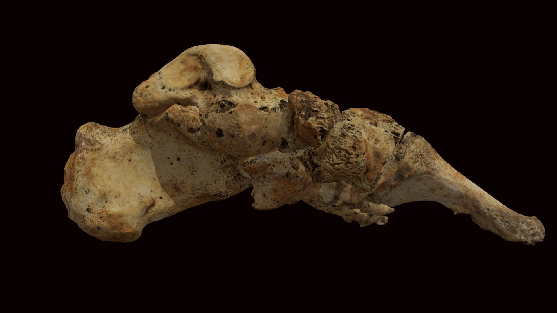Left Foot with Leprosy, Co.Antrim N.Ireland.