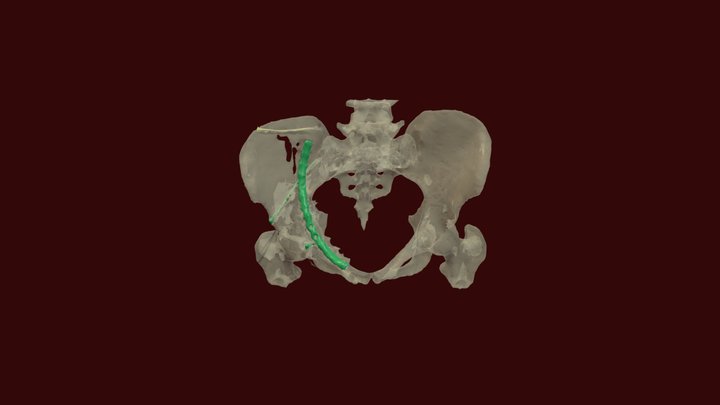 Pelvis Fracture with Hardware 3D Model