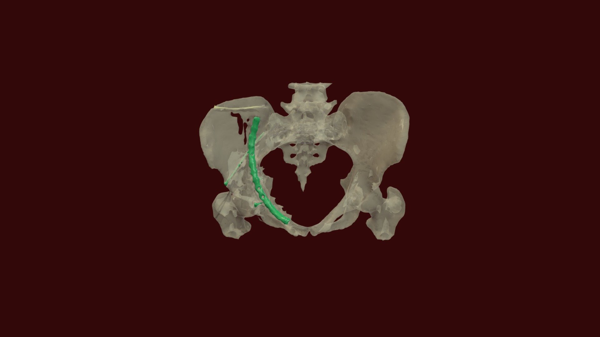 Pelvis Fracture with Hardware