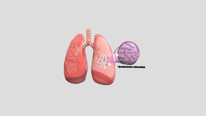 Tuberculosis 3D Model