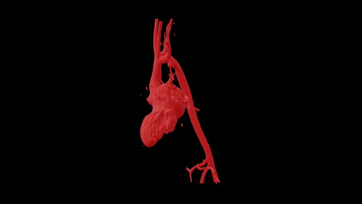 Doble Arco Aórtico - Gabriela Vergara 3D Model