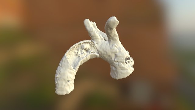 aortic ulcer 3D Model
