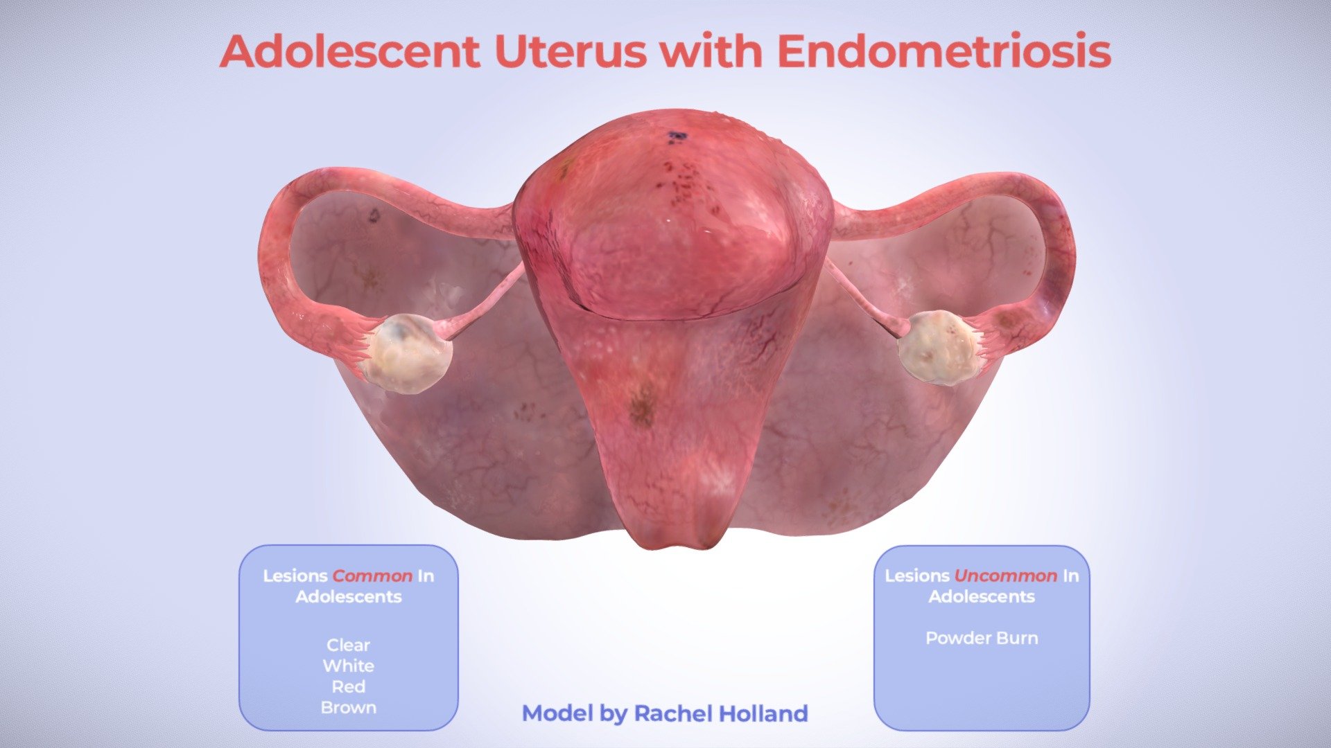 Adolescent Endometriosis: Lesions on the Uterus - 3D model by ...