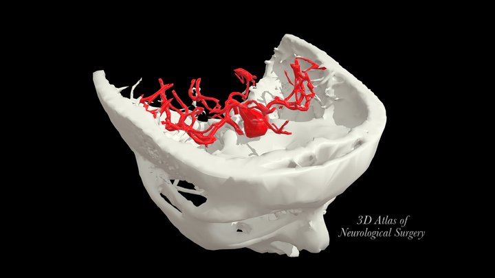 Anterior communicating artery aneurysm 3D Model