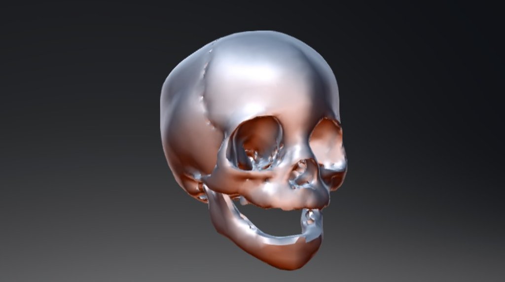 Metopic Craniosynostosis