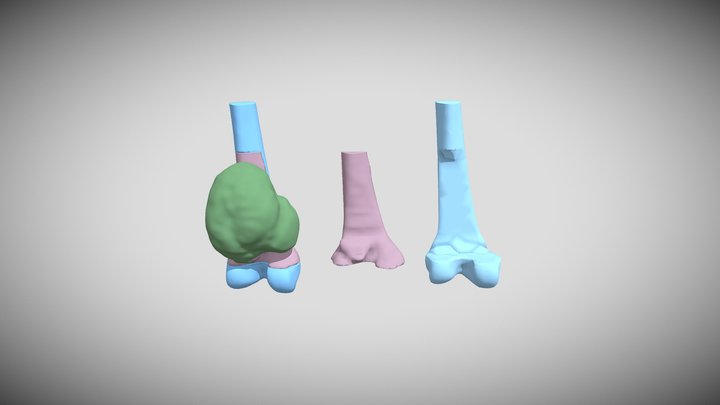 cortado femur tumor 3D Model