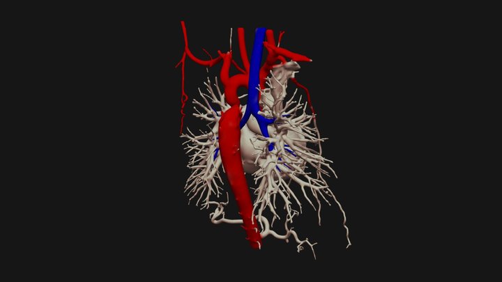 Coarctation 3D Model