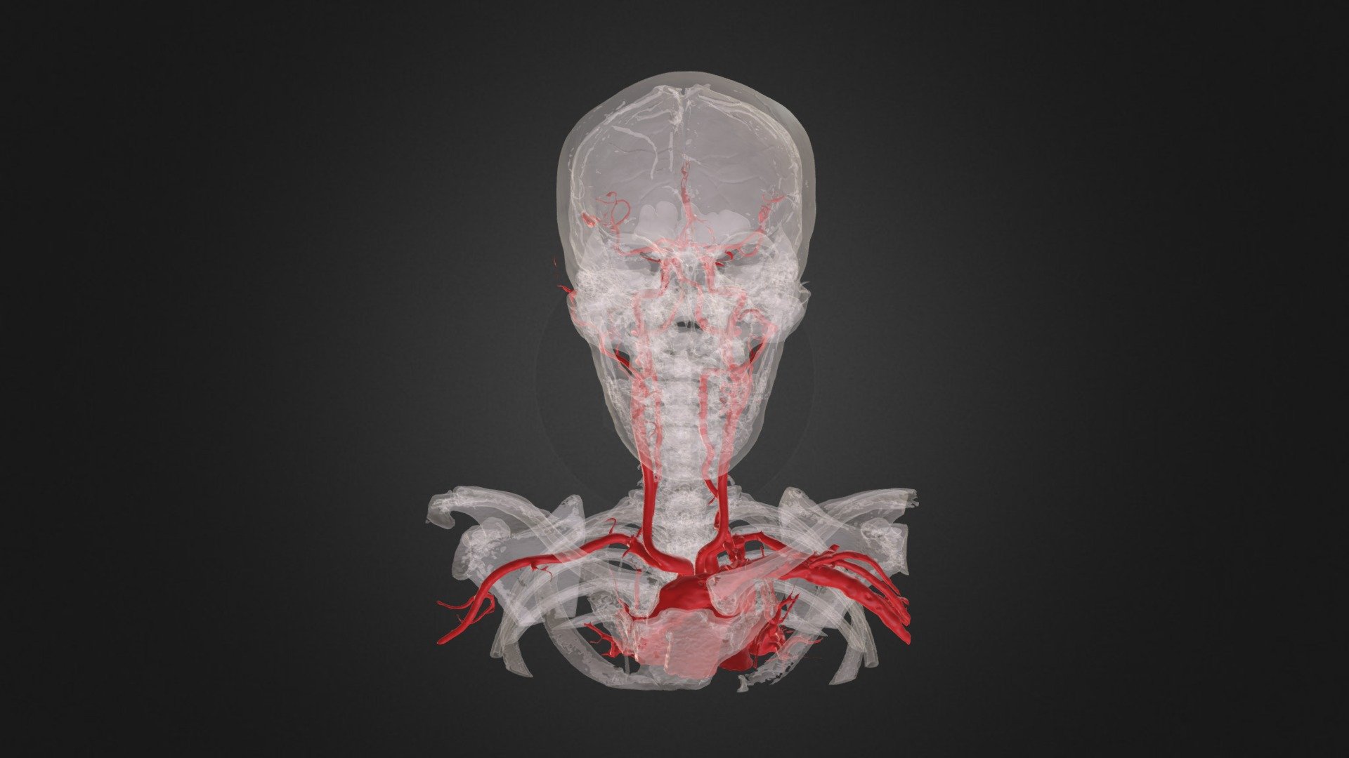 CTA Right Paraophthalmic Aneurysm - 3D model by yuhuihuang [97e7ef4 ...