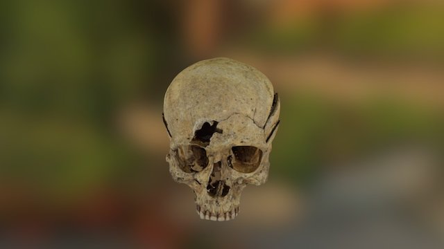 Skull with weapon trauma 3D Model