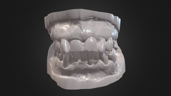 Occlusion Case II 3D Model