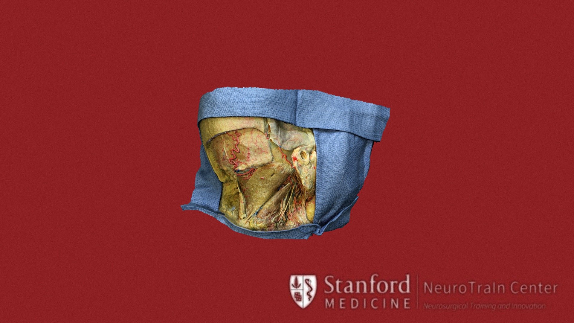 Postero-Lateral dissection - 3D model by vv (@verav) [98d94fc] - Sketchfab