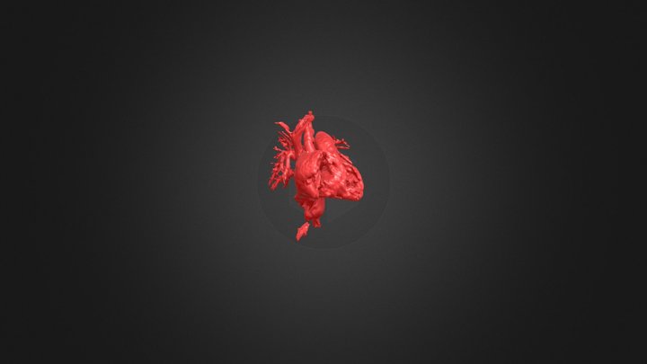 DVAPT infracardiaco 3D Model