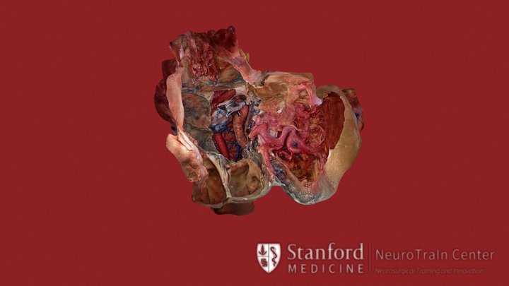 Endoscopic Endonasal Approach 3D Model