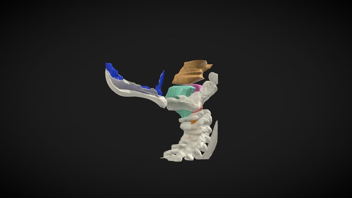 Chiari Malformation 3D Model