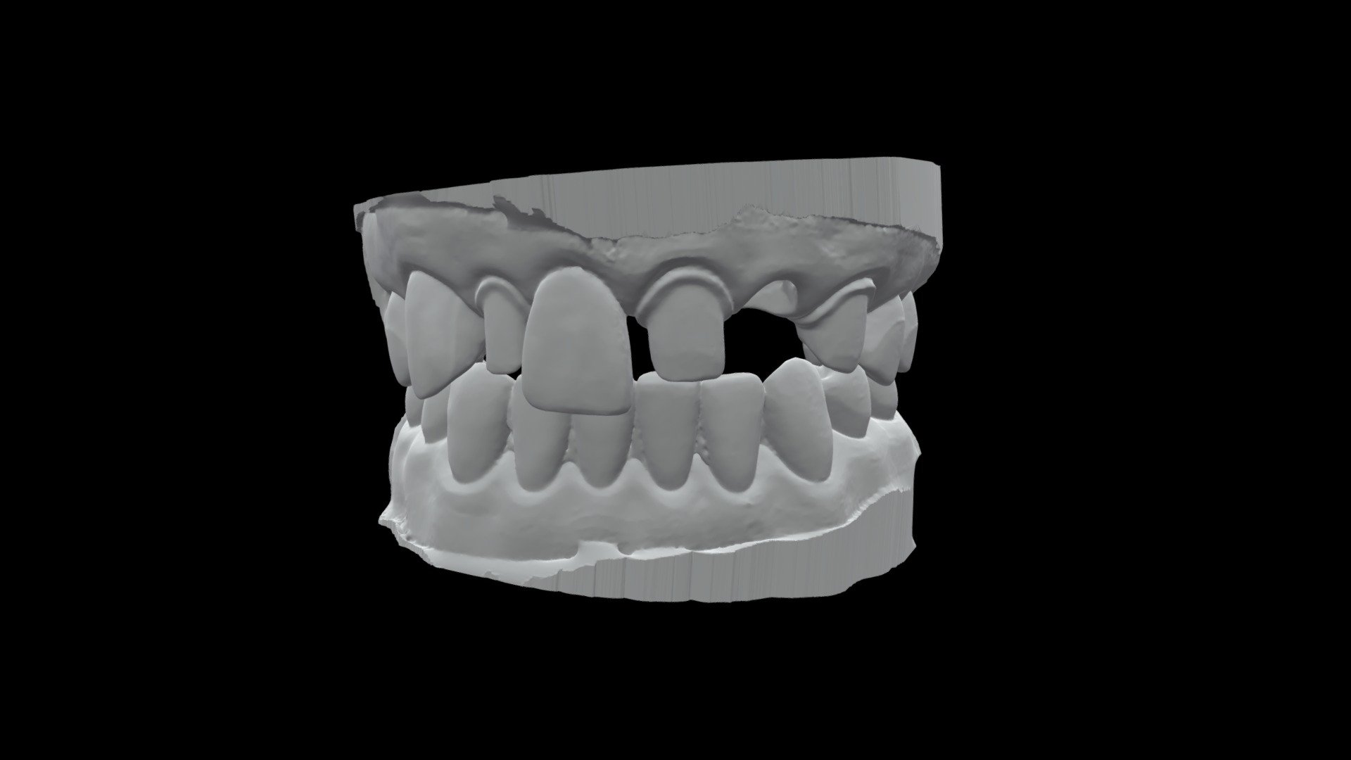 Anterior Single and FPD Articulated - 3D model by bchui [99cb0a2 ...