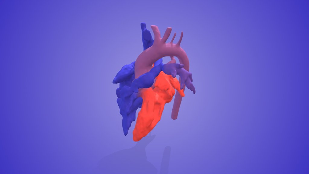 Tetralogy of Fallot