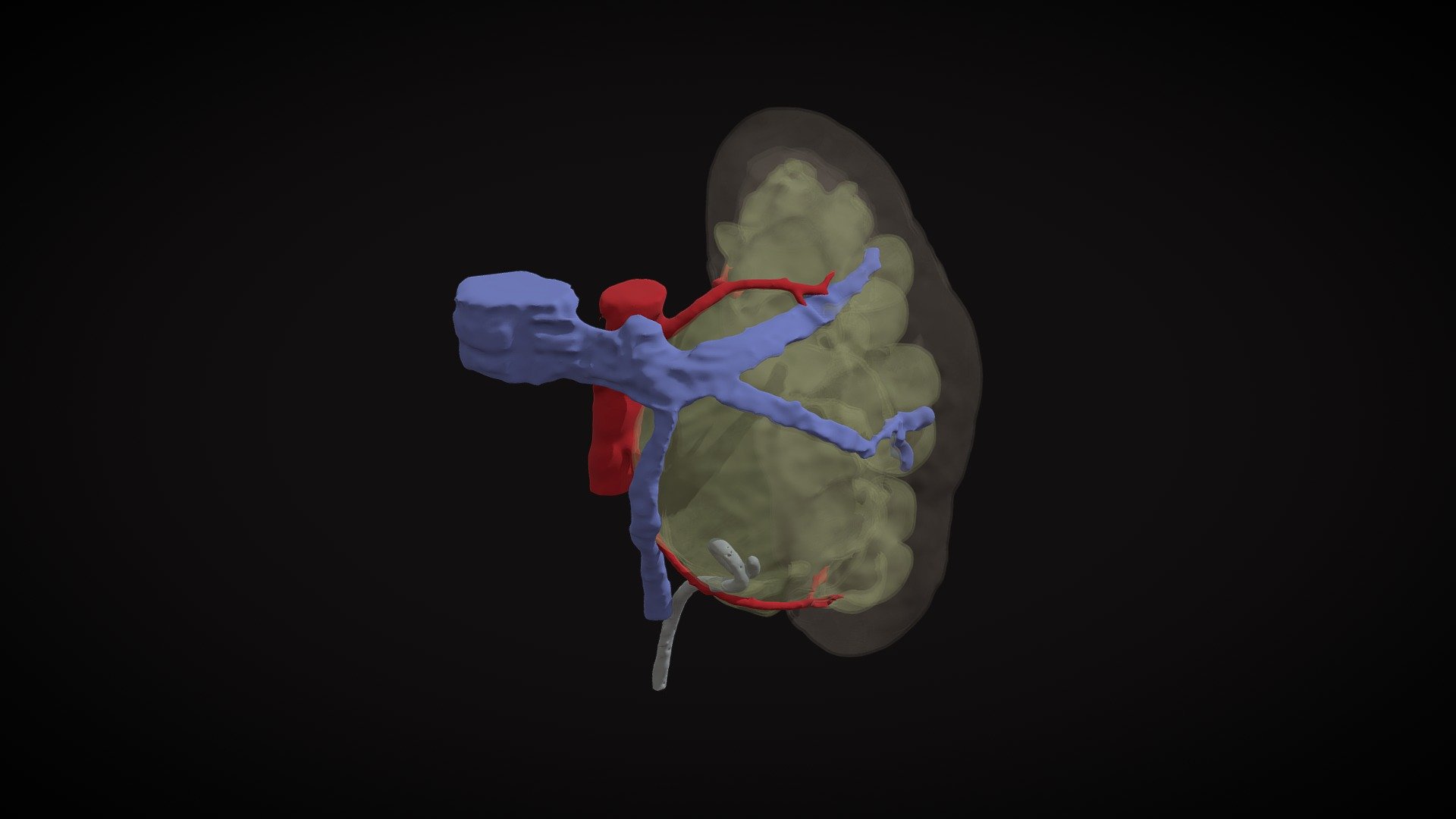 UPJ stenosis in left kidney