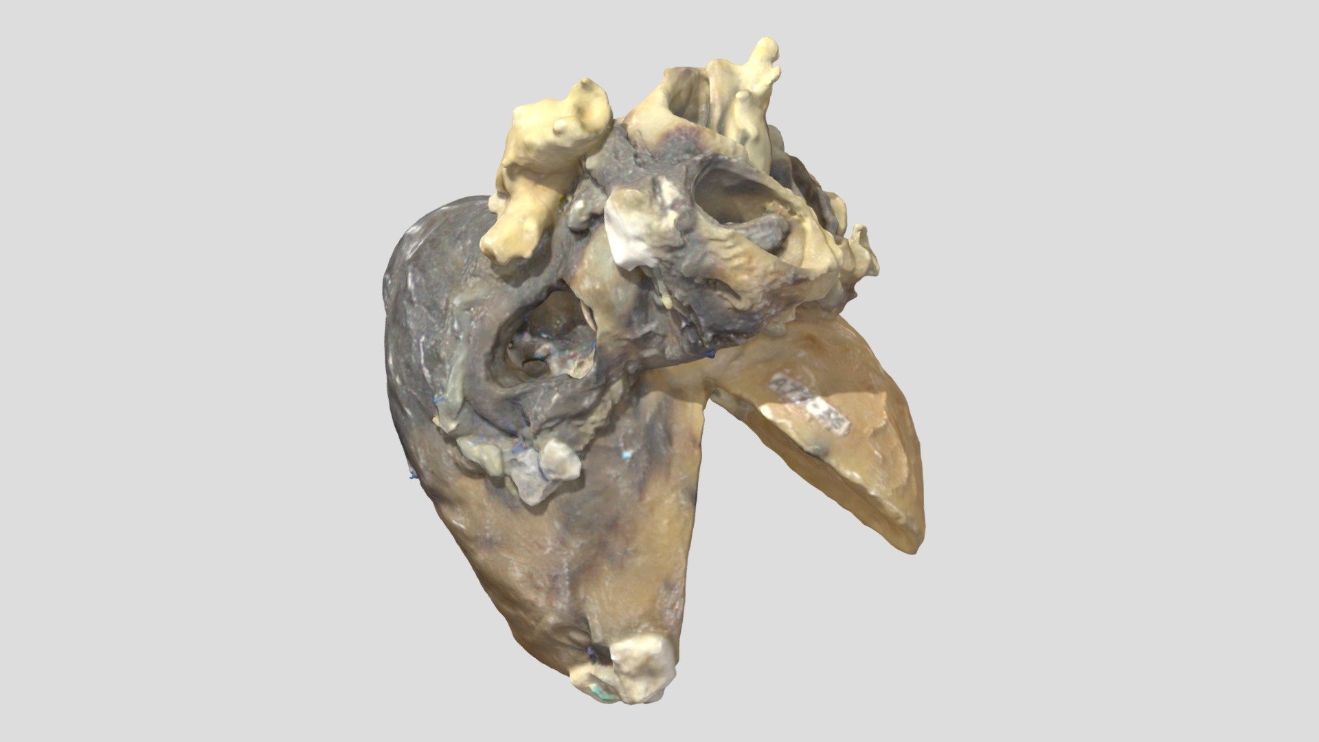 Tetralogy of Fallot_A7856