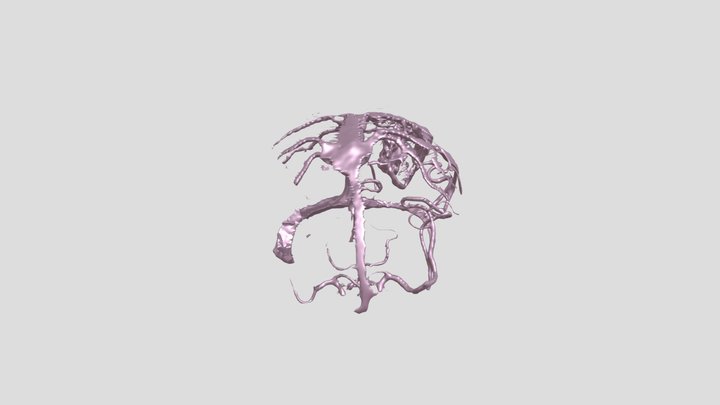 left parietal AVM 3D Model