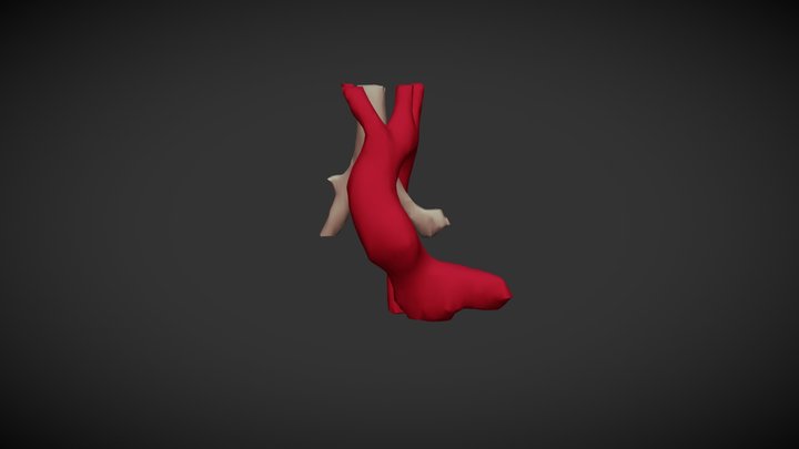 Left arch aberrant right subclavian 3D Model