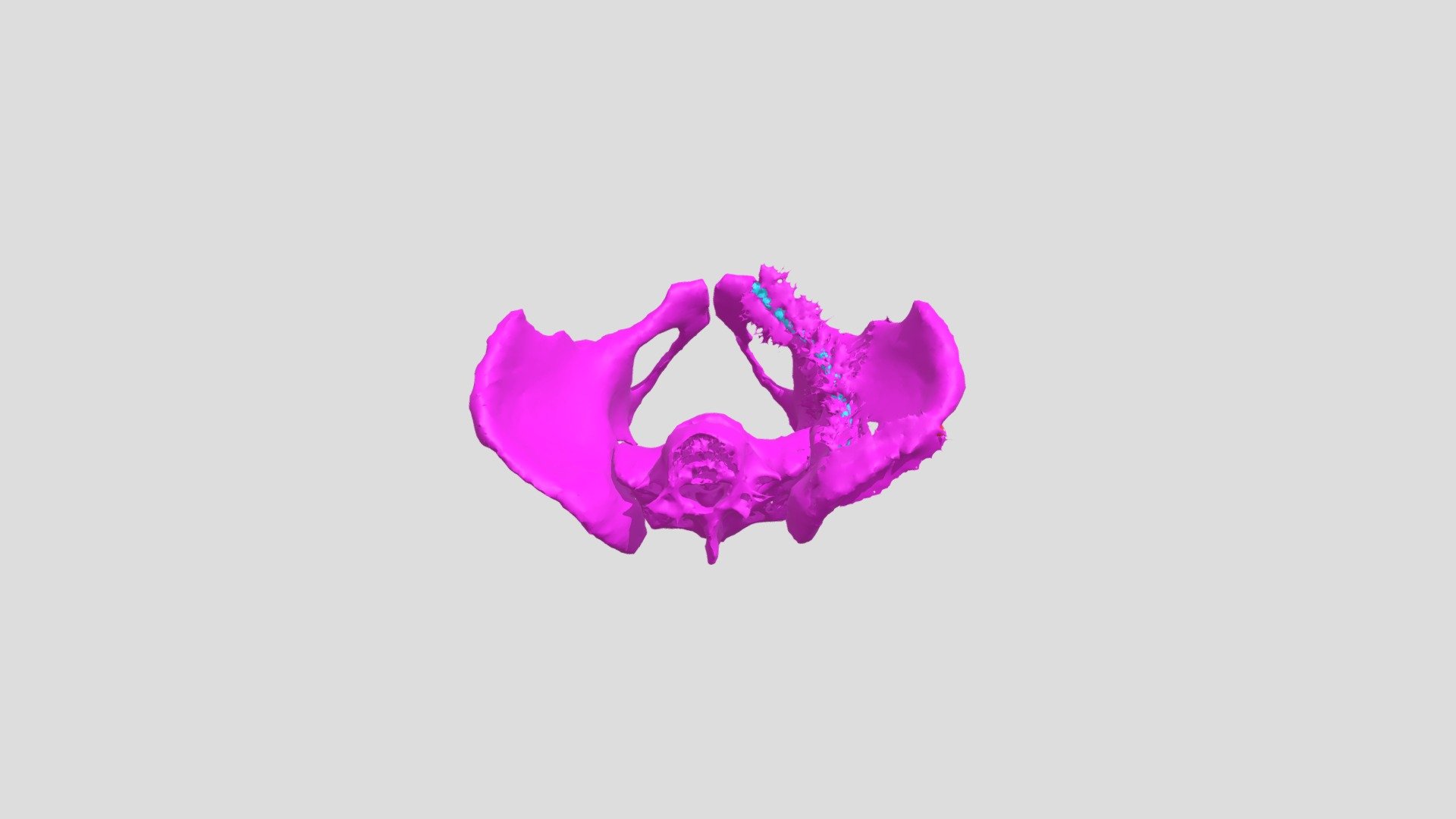 Pelvis Hardware Model