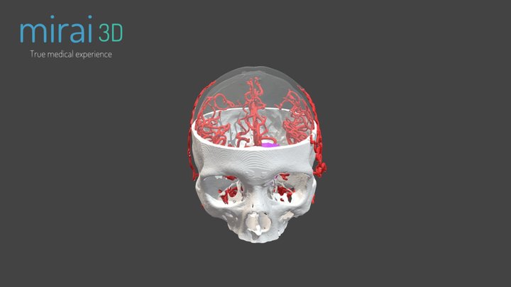 Brain tumor - Skull & blood vessels 3D Model