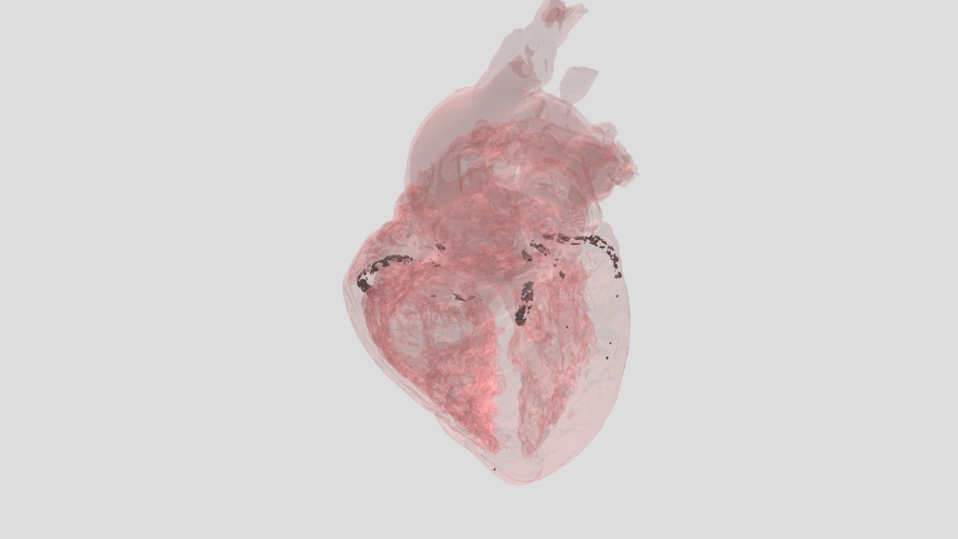 CAD Calcification: HH0144 - Download Free 3D model by VisibleHeartLabs ...