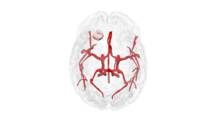 TBI LESION USC Keck 2019 3D Model