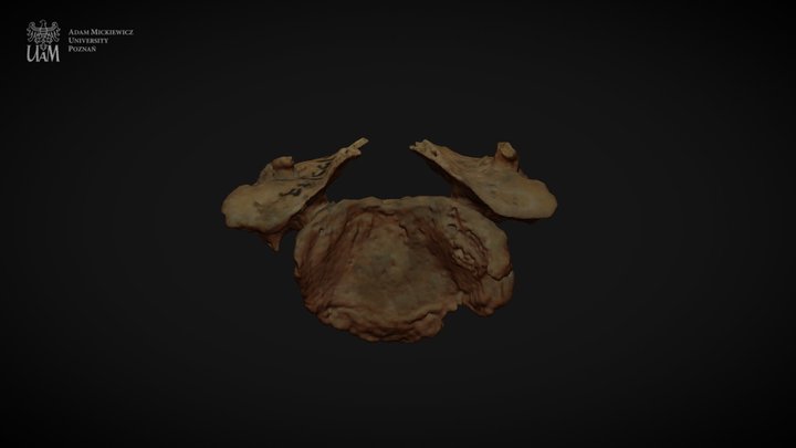Achondroplastic dwarf - C6 3D Model
