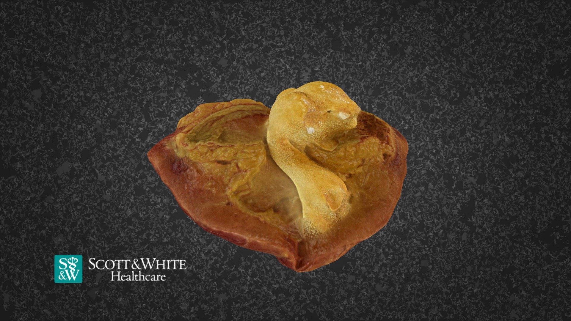 Kidney Staghorn Stone 122259 3D Model By Scott White Moulage   F16f771f2c6d4cd5a2c23673fb949ce3 