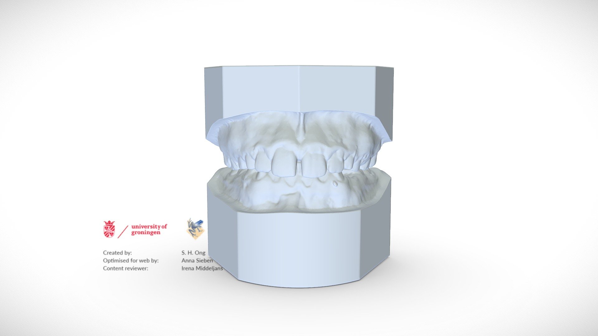 Mixed dentition lower and upper jaw