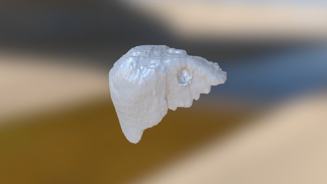 Liverzipnotumor 3D Model