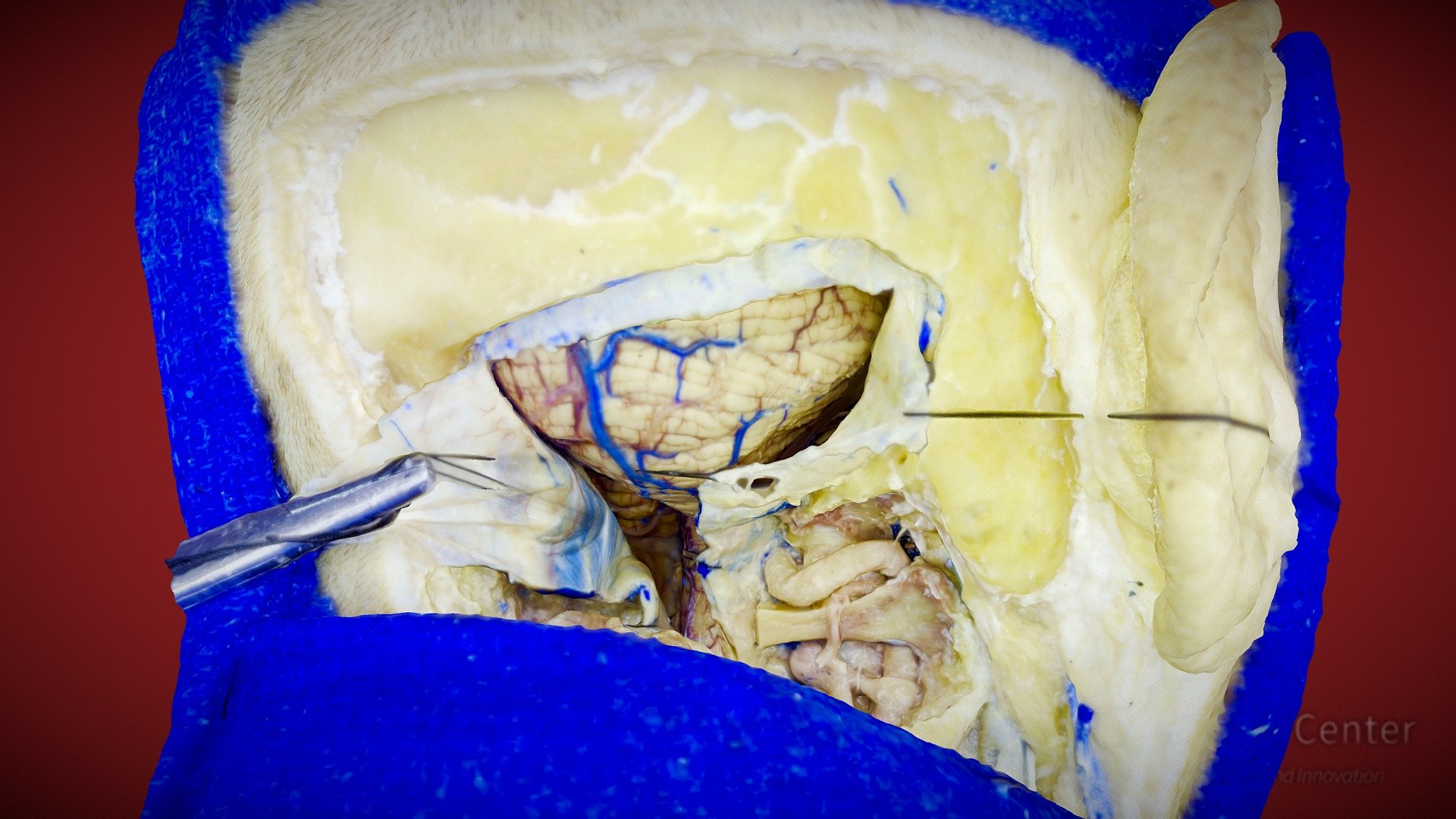 10 - Far Latteral - PD condyle extradural - 3D model by Florencia ...