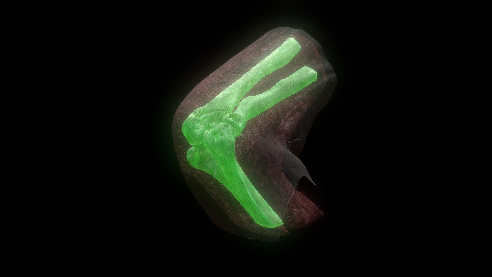 BRON ARM CT