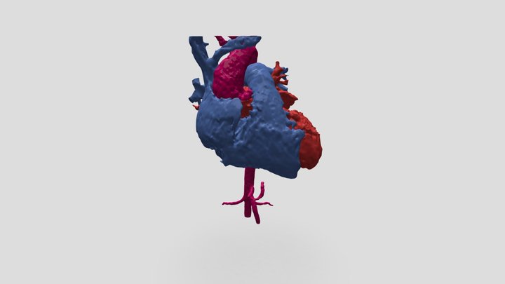 Coarctation of the aorta 3D Model
