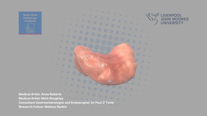 Flat, non-granular lesion with depression #1 © 3D Model