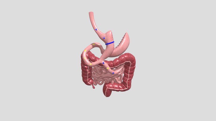 bariatric surgery 3D Model