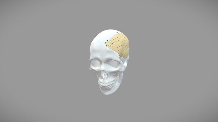 PEEK头颅修补 3D Model