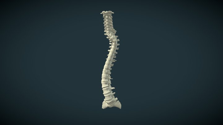 Spine neurofibromatosis dystrophic scoliosis 3D Model