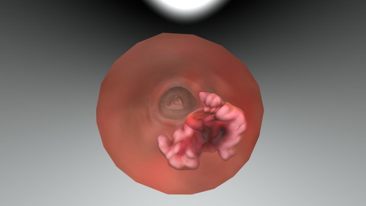 Colon Cancer - The Body VR 3D Model