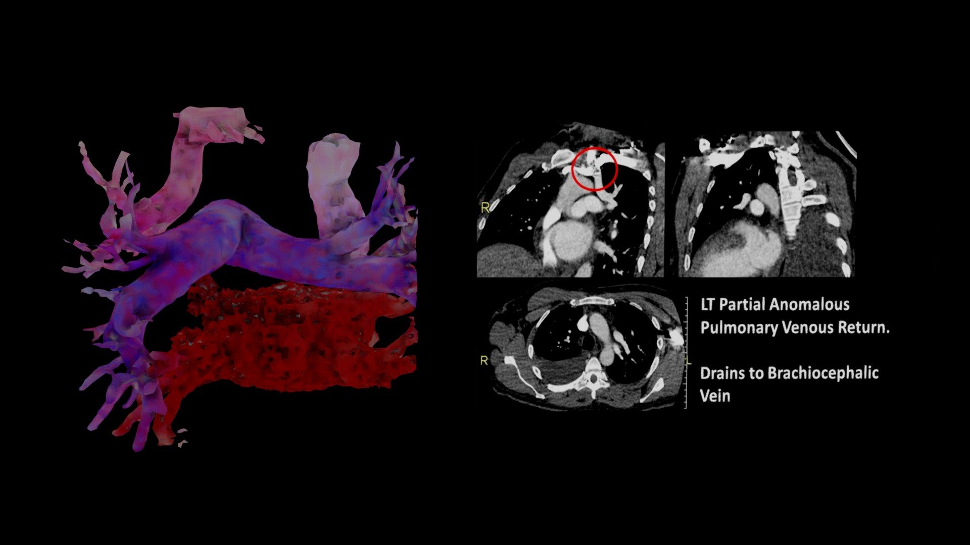 Partial Anom Pulm Vein Ret C