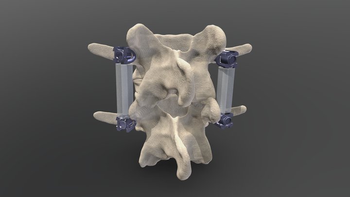 Pedicle-based dynamic stabilization 3D Model