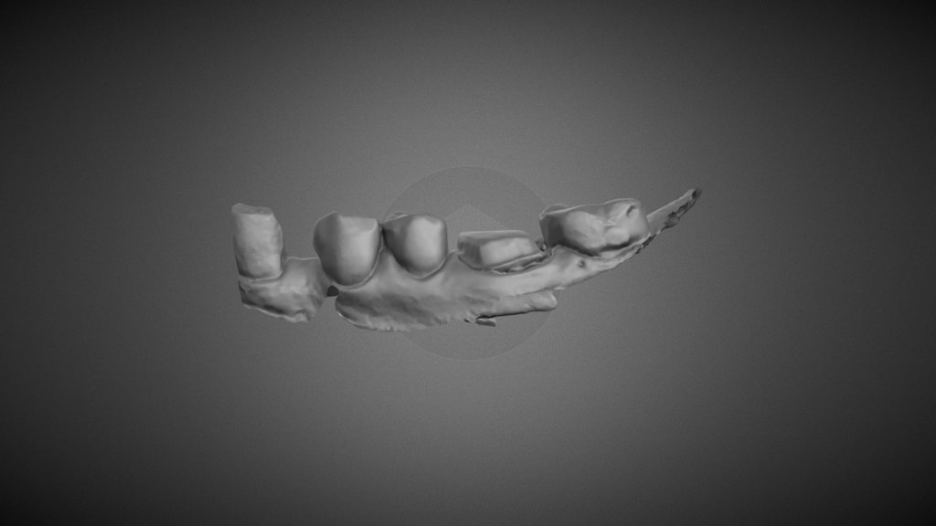 36 FVC-excessive Reduction Decimated