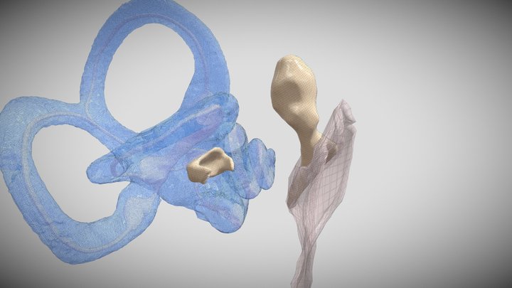Ossicular Chain Reconstruction with TORP 3D Model